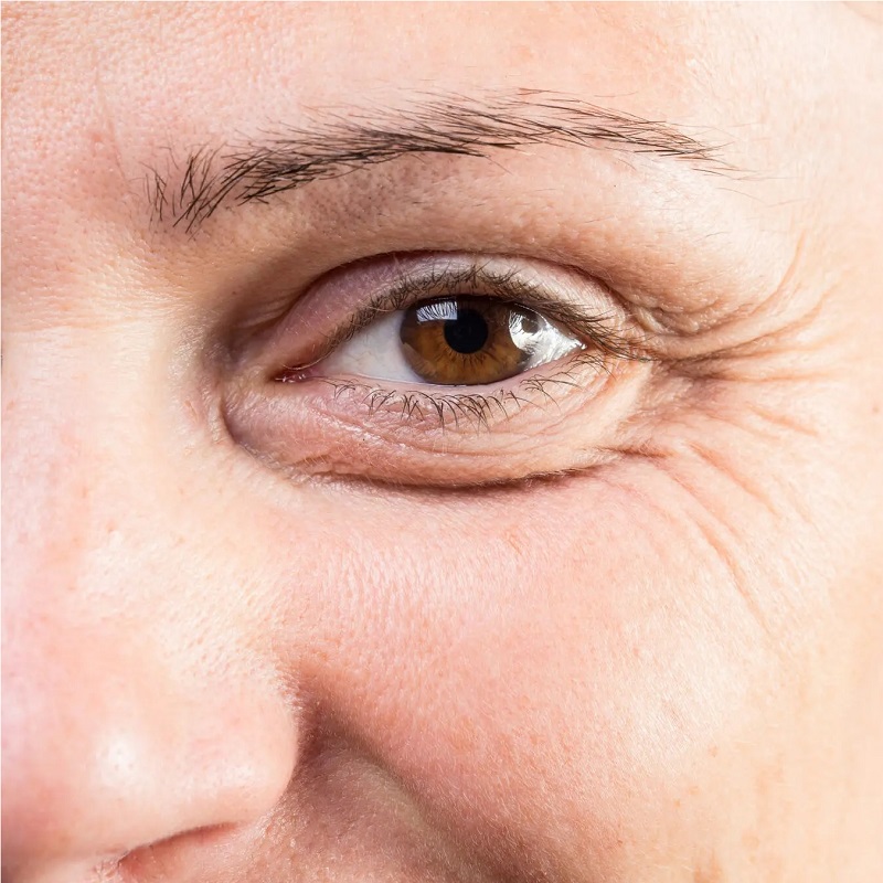Vùng da dưới mắt đặc biệt dễ bị lão hóa vì nó rất mỏng. 