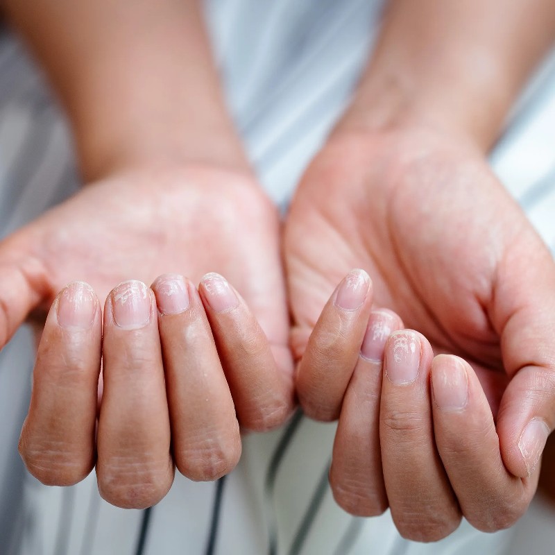 Khô da tay xuất phát từ nhiều nguyên nhân.