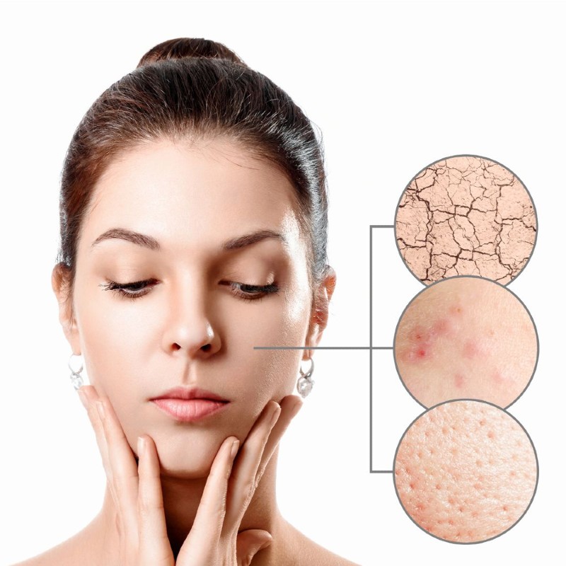 Da khô nên dùng nước hoa hồng, toner để cải thiện tình trạng da.